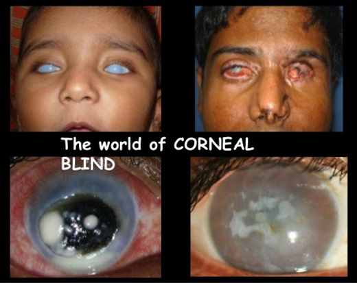Blindness